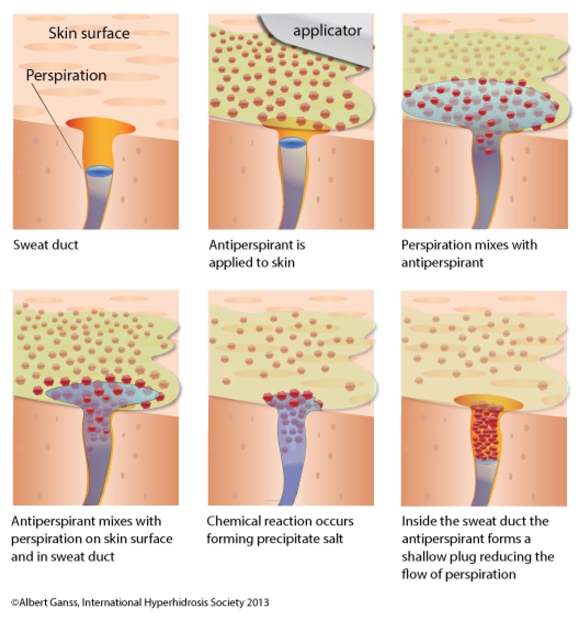 Diagram showing how antiperspirants relieve hyperhidrosis